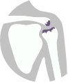 Liečba bolesti ramena - osteoartróza