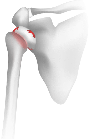 Osteoartróza ramena